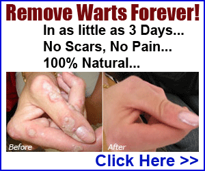 get rid of warts